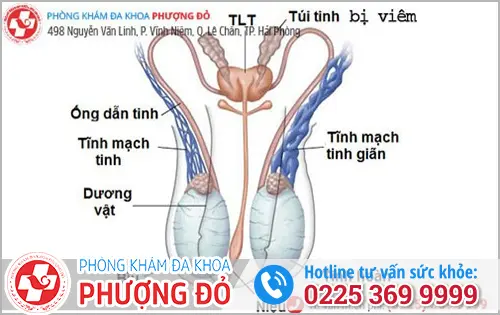 Hình ảnh túi tinh bị viêm