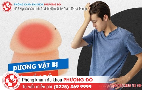 5 “thủ phạm” khiến dương vật nổi mẩn đỏ