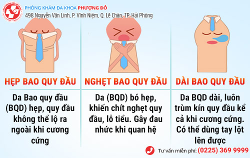 Có nên cắt bao quy đầu không?