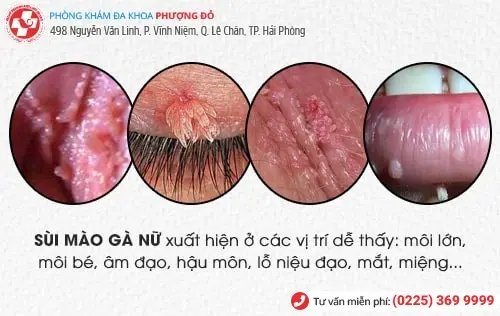 Dấu hiệu bệnh sùi mào gà không phải ai cũng biết