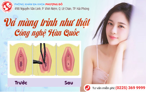 Vá màng trinh và những điều cần biết